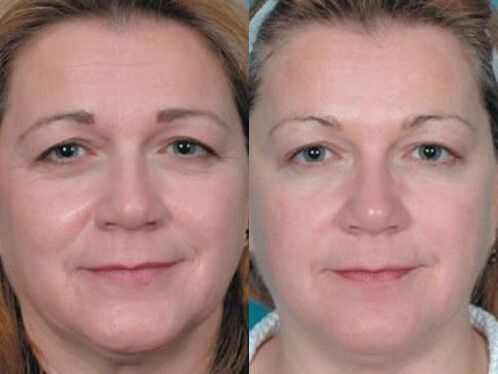 photos of plasma before and after skin rejuvenation