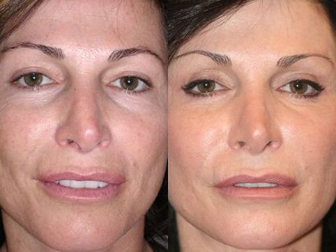 plasma before and after skin rejuvenation