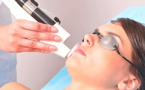 Effects on the facial skin with a laser device