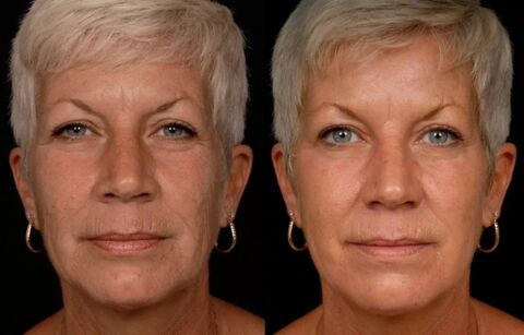 The result of laser treatment of the facial skin - anti-wrinkle