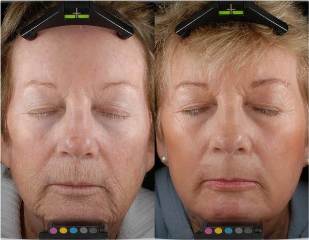 Before and after regeneration with fractional laser