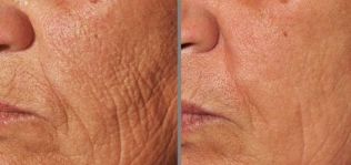 photo before and after fractionated skin rejuvenation