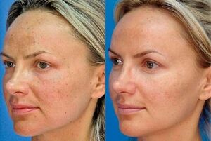 photo before and after skin rejuvenation with the device